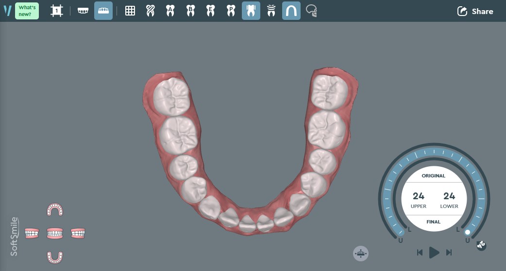 イメージ画像（下部咬合）