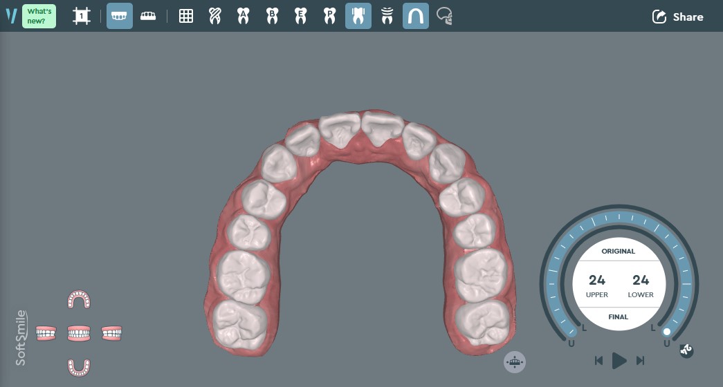 イメージ画像（上部咬合）